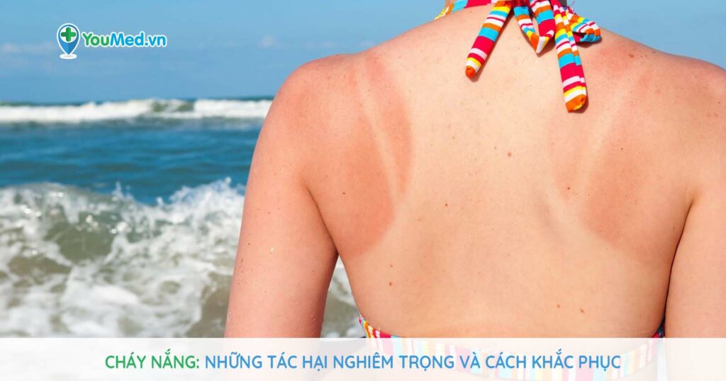 Cháy nắng: Những tác hại nghiêm trọng và cách khắc phục