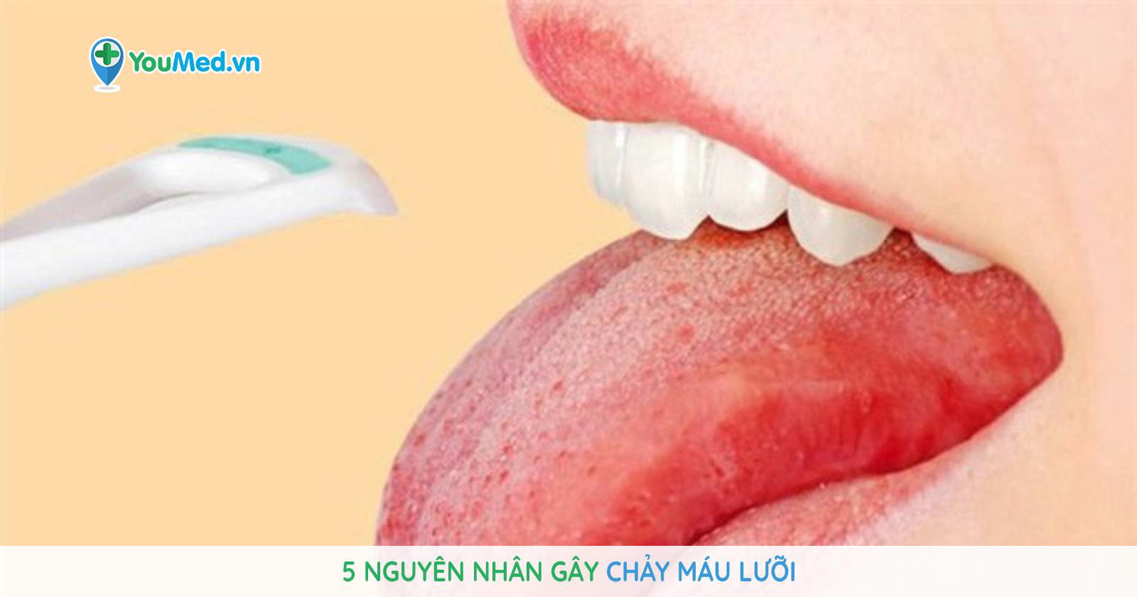 5 nguyên nhân gây chảy máu lưỡi có thể bạn chưa biết - YouMed