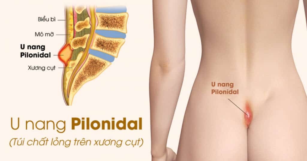 hình ảnh u nang lông vùng xương cùng, hay còn gọi là u nang Pilonidal
