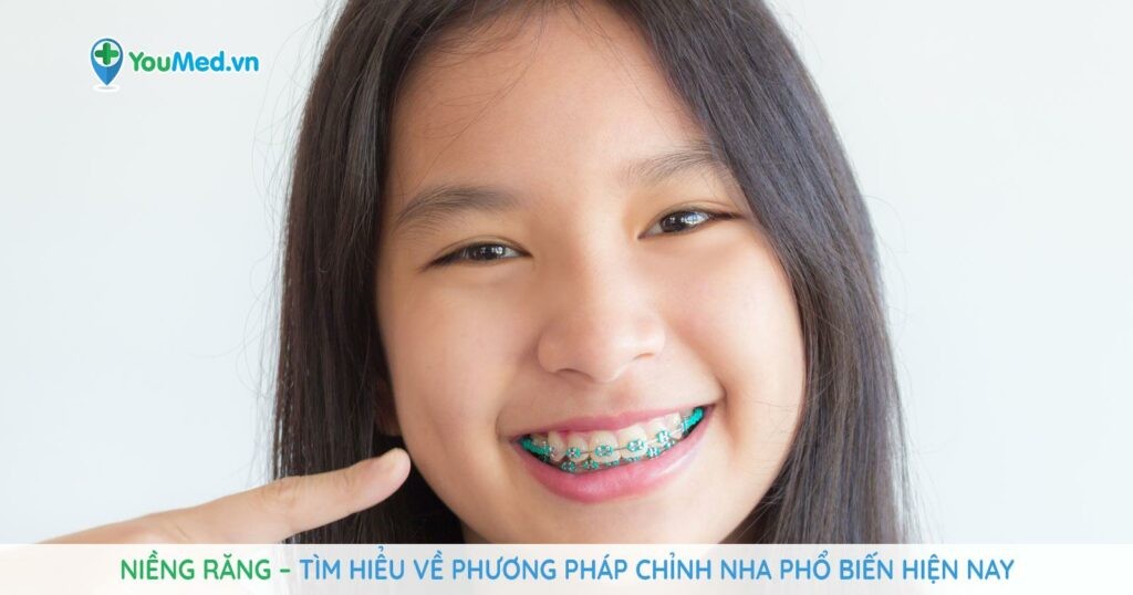 Niềng răng: Phương pháp chỉnh nha phổ biến hiện nay