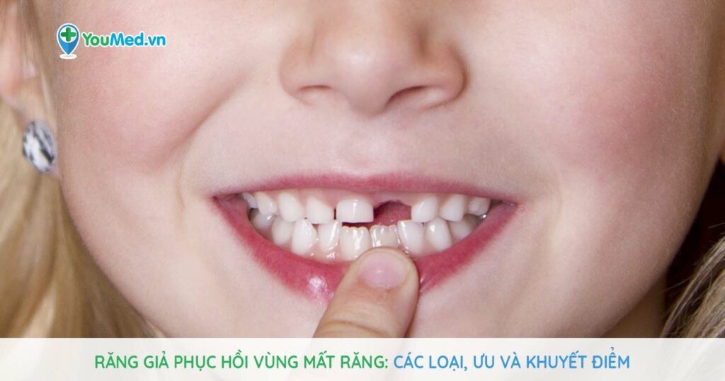 Răng giả phục hồi vùng mất răng: Các loại, ưu và khuyết điểm