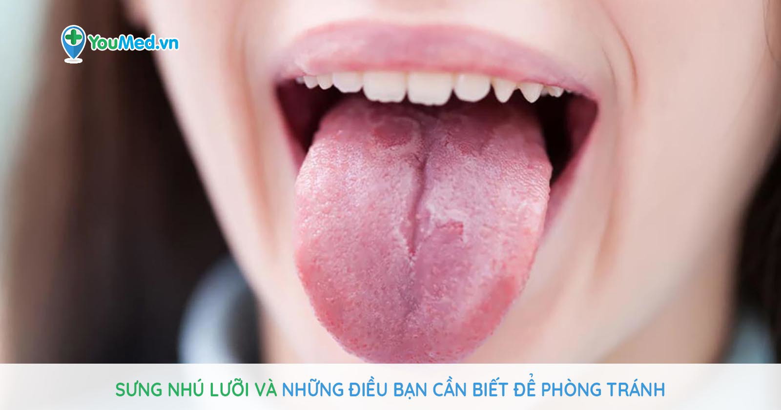 Sưng nhú lưỡi và những điều bạn cần biết để phòng tránh