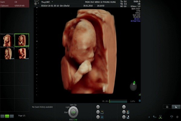 Hình ảnh siêu âm thai nhi 4D