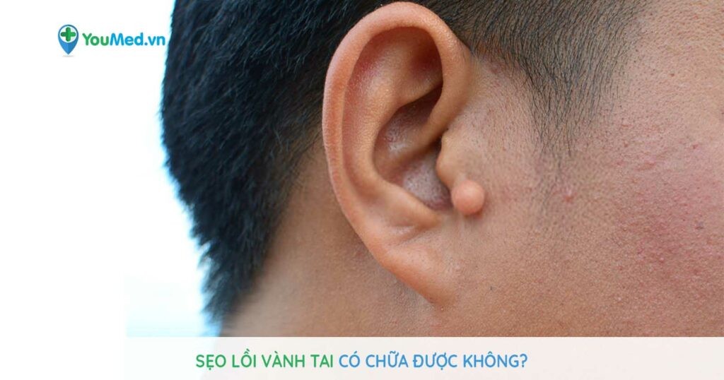 Sẹo lồi vành tai là gì? Có chữa được không?
