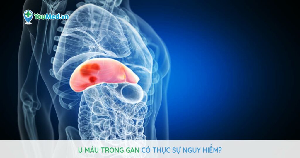 U máu trong gan có thực sự nguy hiểm?