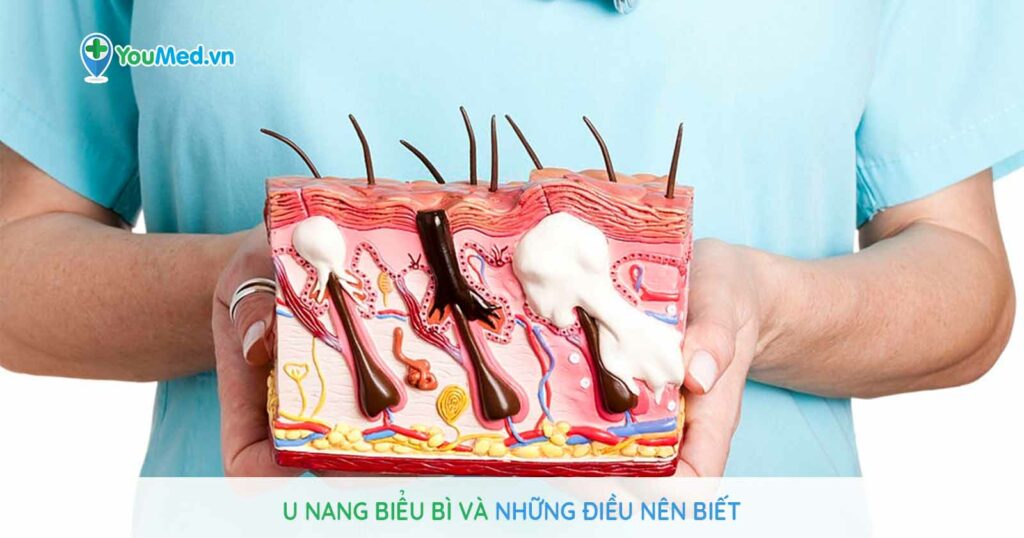 U nang biểu bì và những điều nên biết