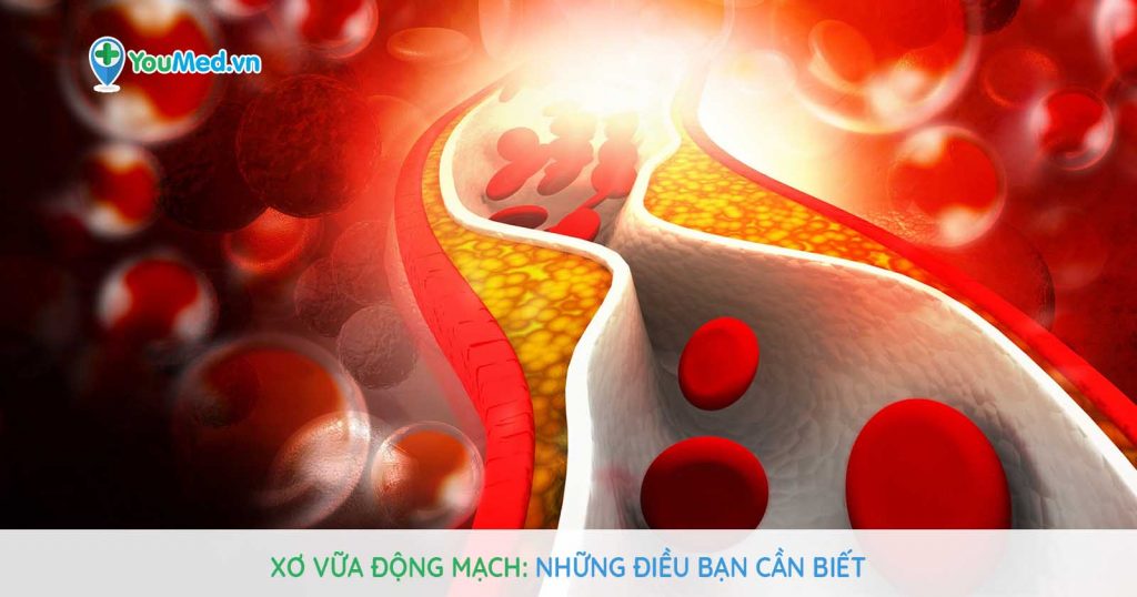 Xơ vữa động mạch: Những điều bạn cần biết