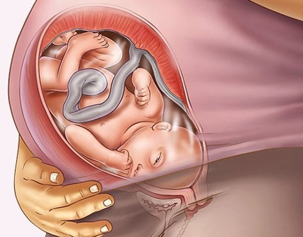 Ít nước ối hay tư thế bất thường trong tử cung có liên quan đến bàn chân khoèo