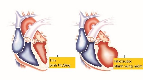 Khác biệt giữa cơ tim bình thường và cơ tim Takotsubo