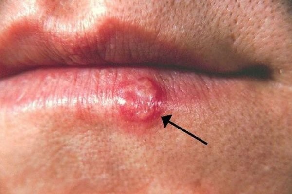 Herpes môi