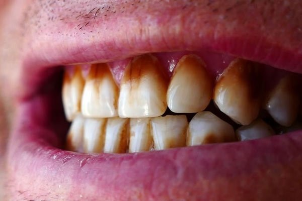 Có nhiều nguyên nhân dẫn tới răng nhiễm màu