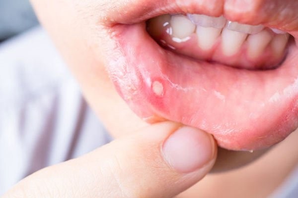 Miệng bị lở loét không hoàn toàn là bệnh răng miệng và có thể cải thiện