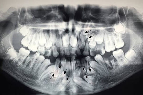 Thừa răng là tình trạng có nhiều răng hơn bình thường