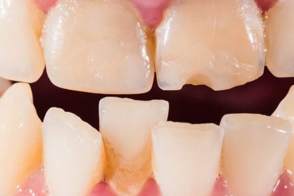 Khi răng xô lệch, các phương pháp chỉnh nha sẽ được áp dụng