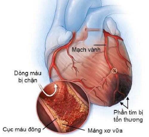 Nhồi máu cơ tim: nguyên nhân gây block nhánh
