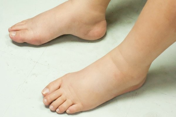 Phù chân thường ít vào buổi sáng khi ngủ dậy và tăng dần trong ngày