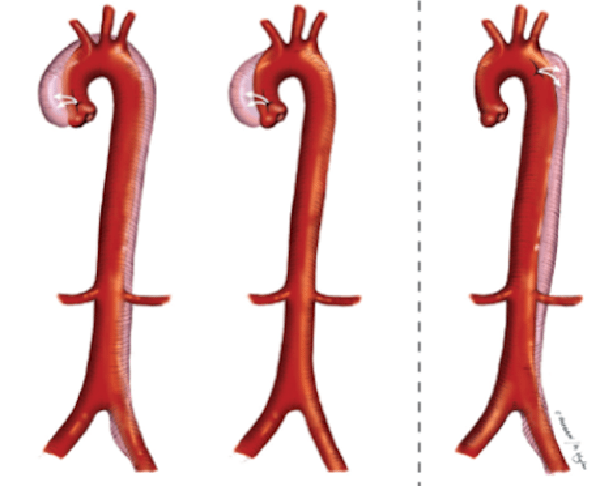 3 dạng bóc tách động mạch chủ ngực