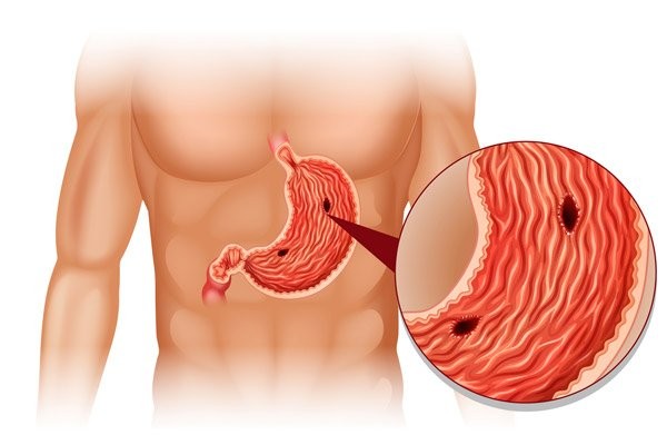 Thủng dạ dày là biến chứng nguy hiểm của loét và ung thư dạ dày