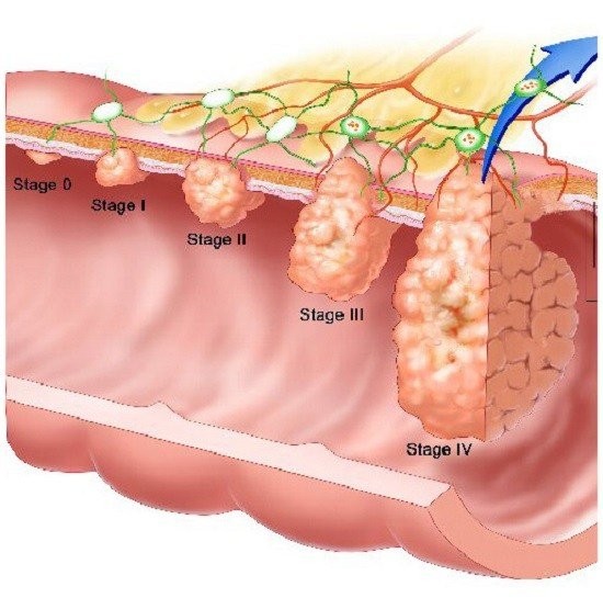Các giai đoạn (Stage) của ung thư. Giai đoạn IV các tế bào sẽ di căn tới cơ quan khác (di căn xa) như não, gan, xương, phổi
