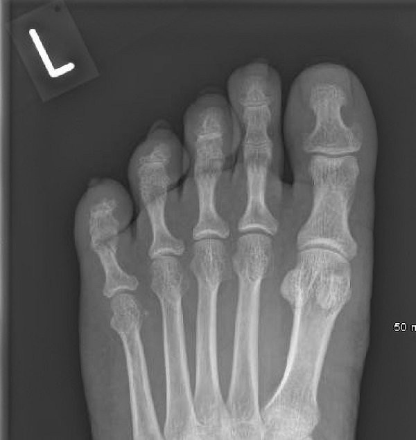 Ảnh chụp X-quang ngón chân trái