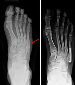 X quang trước và sau khi phẫu thuật gãy xương bàn chân