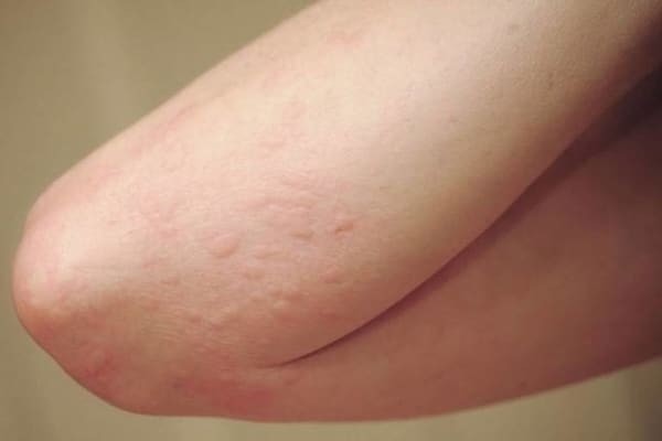 Bạn có biết vì sao bị muỗi đốt gây ngứa không?