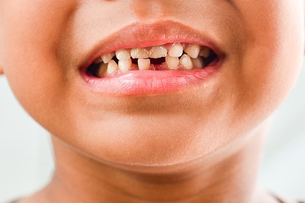 Sâu răng là bệnh lý thường gặp ở trẻ em