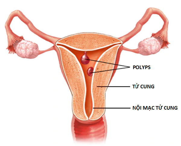 khối polyp trong tử cung