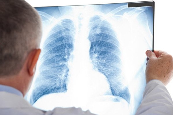 Nếu nghi ngờ tràn dịch màng phổi, bác sĩ sẽ tiến hành chụp X quang phổi