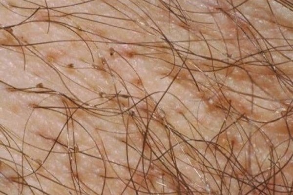 Sang thương vùng da rận mu và trứng ở vùng lông mu 