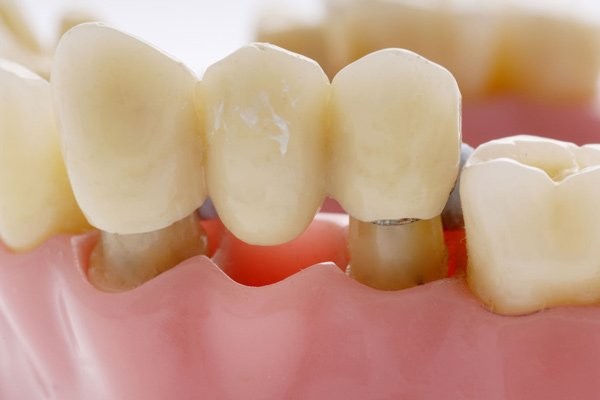 Cầu răng có thể thực hiện cho nhiều lứa tuổi