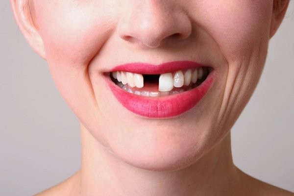 Tùy vào tình trạng mà bạn nên lựa chọn phương pháp làm răng giả phù hợp