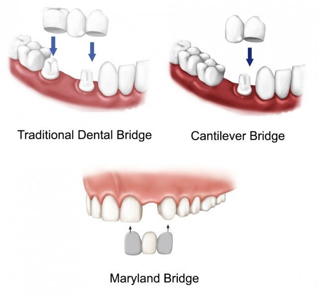 Các loại cầu răng theo cấu trúc