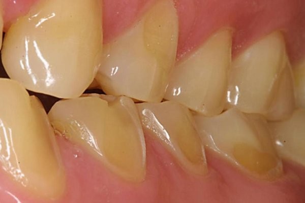 Răng nhạy cảm do mòn răng