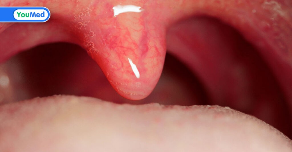 Sưng lưỡi gà: nguyên nhân, triệu chứng và cách điều trị