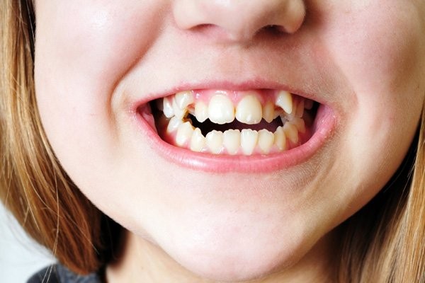 Răng của trẻ có thể bị ảnh hưởng