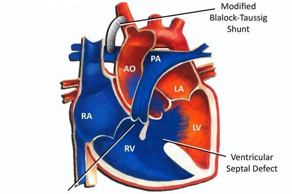 Ống nối (shunt) được gắn giữa động mạch chủ (đỏ) và động mạch phổi (xanh)