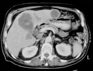 Hình ảnh X-Quang của khối ung thư túi mật