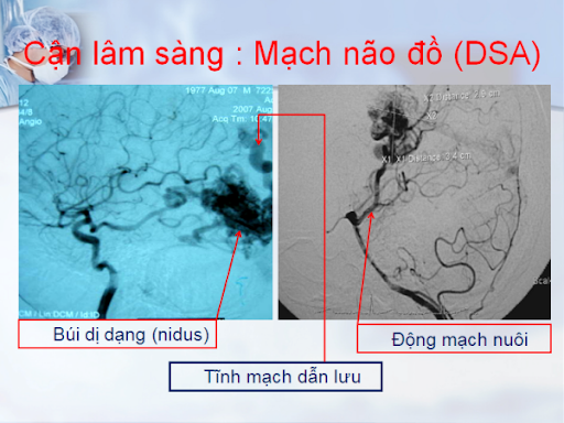 mạch não đồ DSA