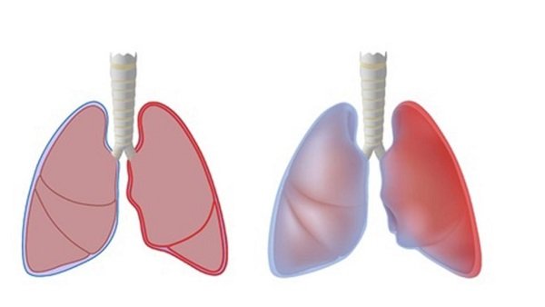 Màng phổi bình thường bên Trái, màng phổi bị viêm bên Phải