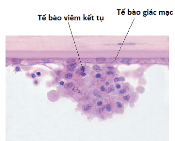 Hình ảnh tế bào viêm dính vào mặt sau tế bào giác mạc