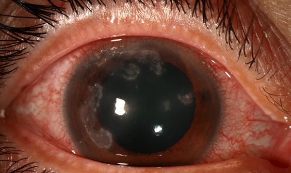 Ciliary Injection gây đỏ mắt ở viền mống mắt