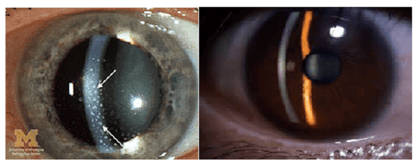 Các tế bào bất thường ở tiền phòng - trước mống mắt (trái). Tiền phòng bình thường (phải)