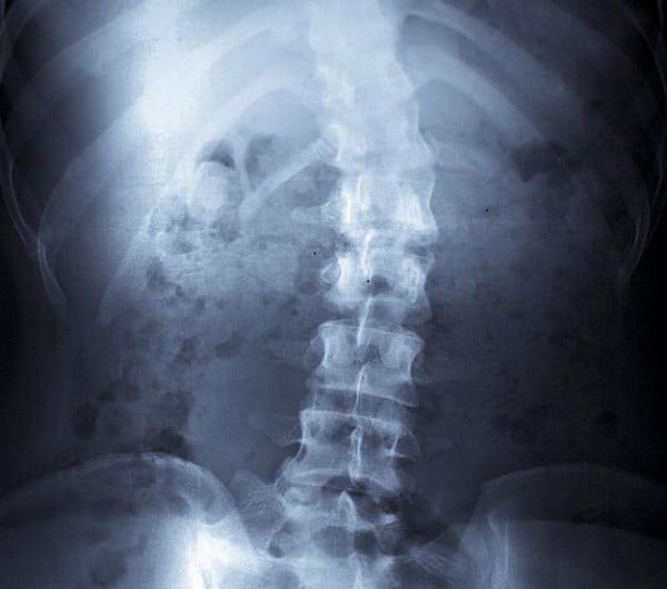 Hình ảnh vẹo cột sống trên phim X quang bệnh nhân u sợi thần kinh.