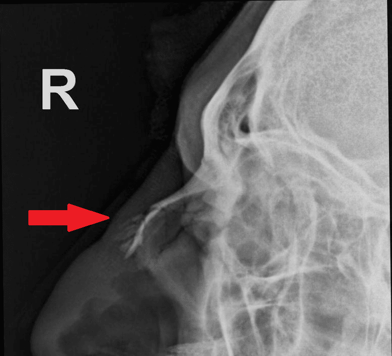 Hình ảnh gãy xương mũi trên phim X quang