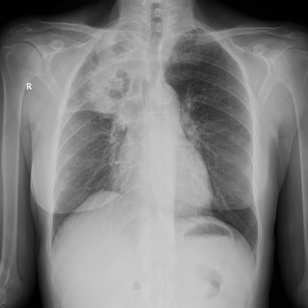 X-quang một bệnh nhân bị bệnh nhiễm aspergillus thể xâm nhập