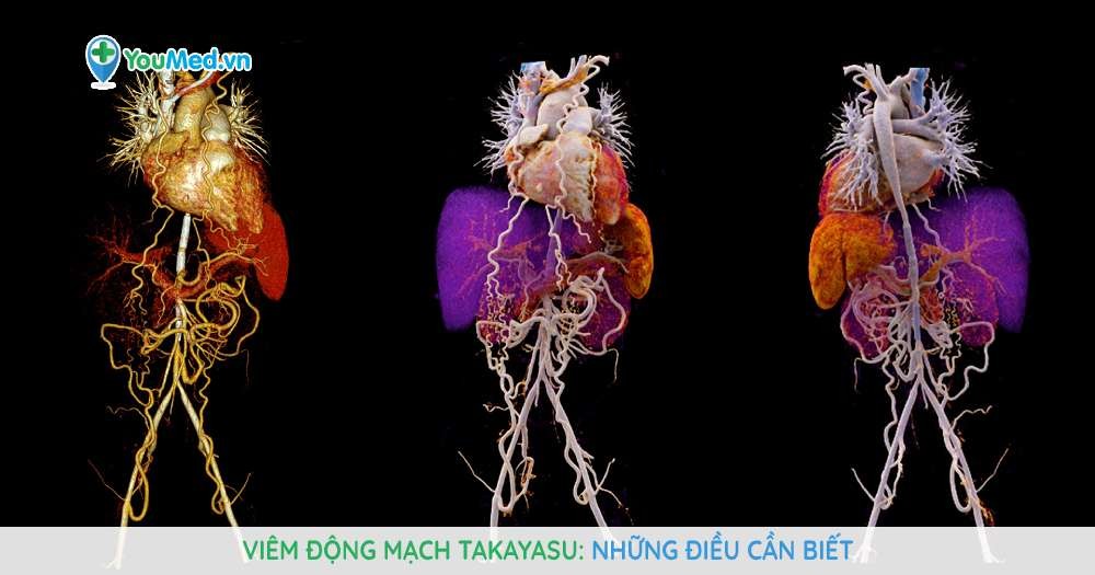 Viêm động mạch Takayasu: Những điều cần biết