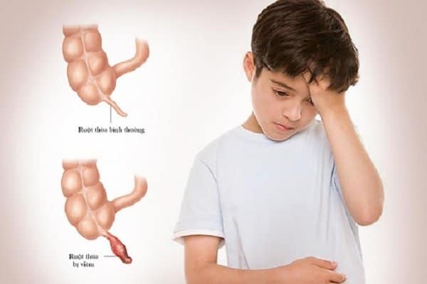 Viêm ruột thừa ở trẻ em