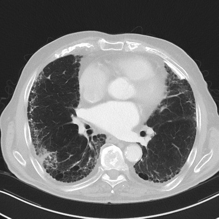 Bệnh bụi phổi amiăng trên CT scan ngực