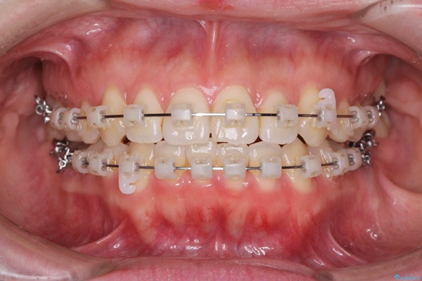 Có thể cải thiện răng thưa bằng niềng răng